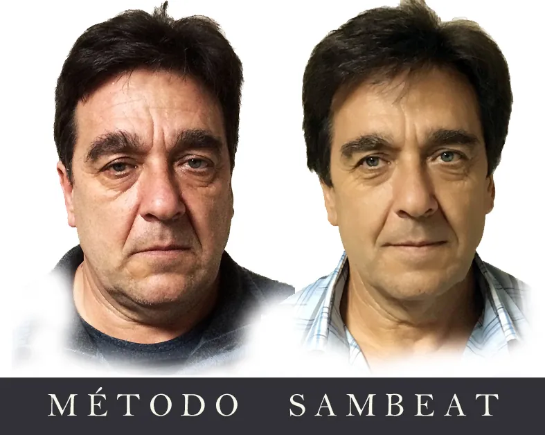 Caso real antes y después con el Método Sambeat Comparativa visual de antes y después de un caso real tratado con el Método Sambeat